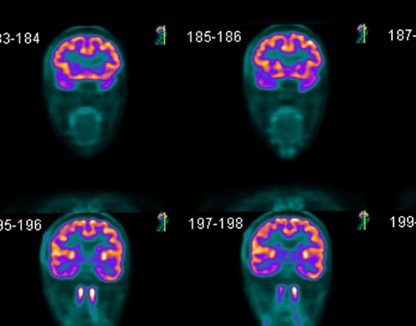 Brain Imaging Tests