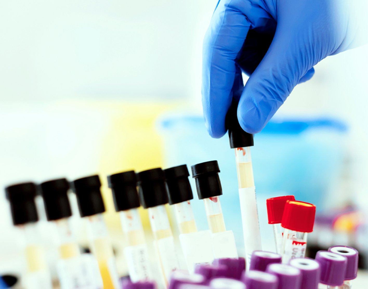 creatinine-urine-test