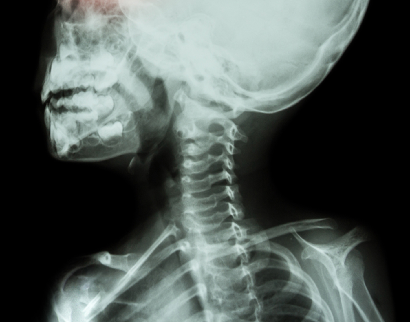 healthy cervical spine xray