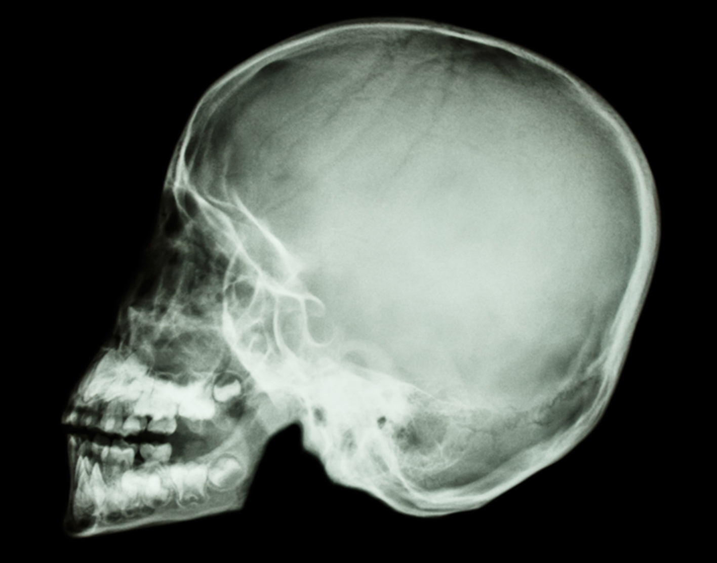fractured skull x ray
