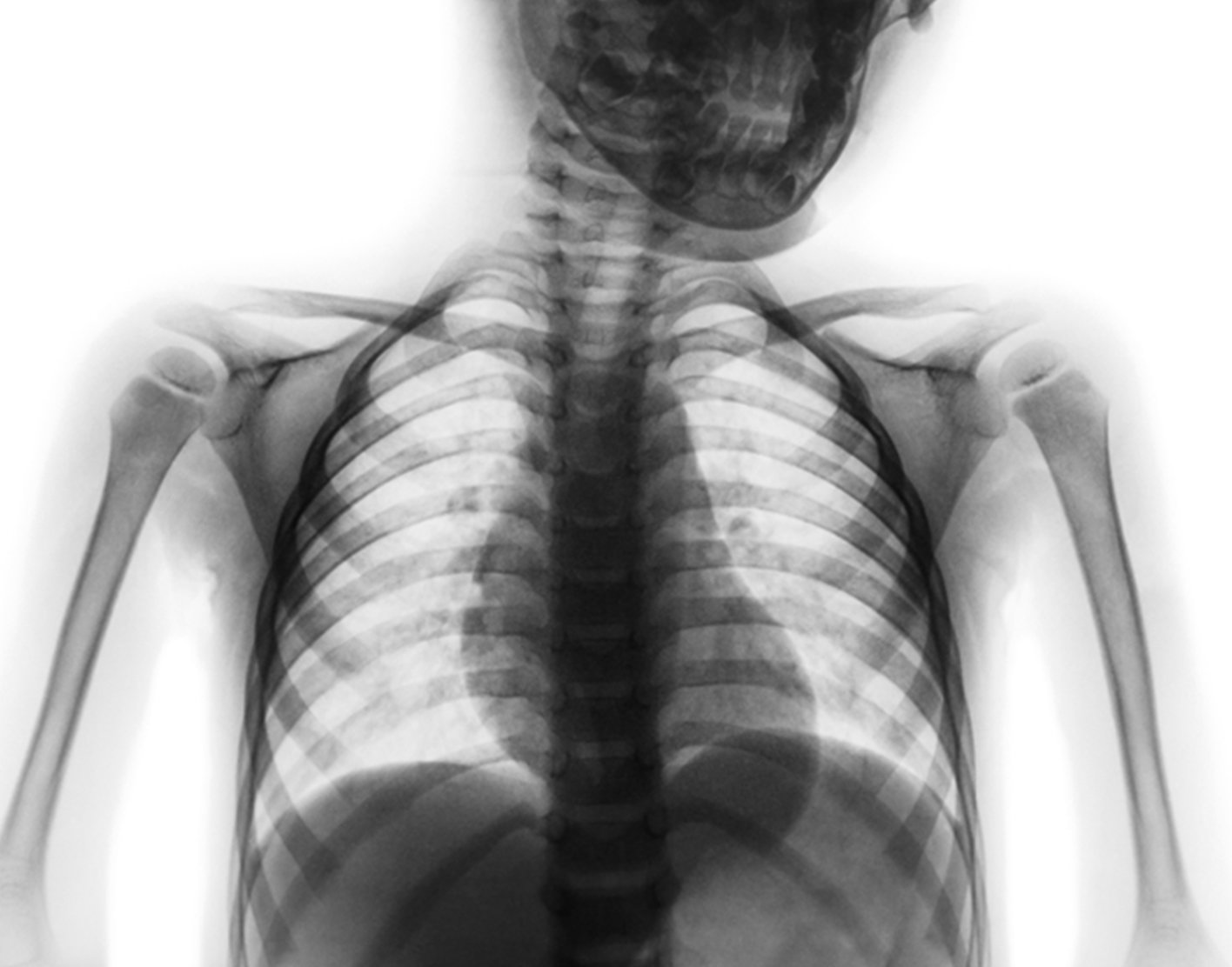 Does insurance cover x rays information